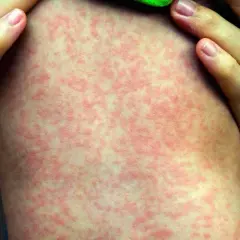 Macchie rosse sulla pelle bambini, un'eruzione cutanea diffusa che potrebbe richiedere attenzione medica.