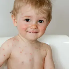 Czy dziecko ze strupami po ospie może iść do przedszkola? Fakty