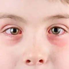 Alergia oczu: objawy, rozpoznanie i skuteczne sposoby na ulgę