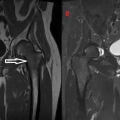 Risonanza magnetica pelvica: edema osseo nel femore sinistro, che potrebbe indicare un tumore.