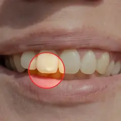 Dente con macchia gialla evidenziata da un cerchio rosso, circondato da gengive bianche e altri denti sani.