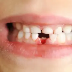 Kiedy wypada pierwszy ząb? Przewodnik dla rodziców (wiek, objawy)