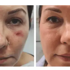 Przed i po zabiegu z użyciem egzosomów. Skóra twarzy przed zabiegiem jest zaczerwieniona i podrażniona, po zabiegu jest wygładzona i zregenerowana.