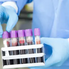 Ręce w niebieskich rękawiczkach trzymają stojak z probówkami krwi. Anty TG cena badań jest kluczowa dla diagnostyki.