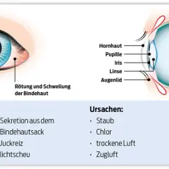 Wirksame Medikamente gegen Bindehautentzündung: Tipps und Empfehlungen