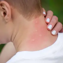Rote, geschwollene Stellen am Hals, deutliche Anzeichen einer starken Schwellung nach Insektenstich.