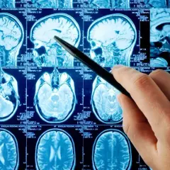Rezonans magnetyczny a choroby psychiczne: co naprawdę wykryje MRI?