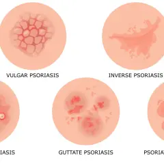 Różne rodzaje łuszczycy: plamy łuszczycy plackowatej, łuszczycy odwróconej, łuszczycy krostkowej, łuszczycy kropelkowatej i łuszczycy erytrodermii.