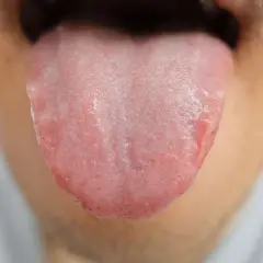 Lingua arrossata e irritata, con papille evidenti, che suggerisce un bruciore alla lingua.