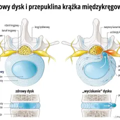 Porównanie zdrowego krążka międzykręgowego z jego przepukliną, która uciska nerwy. Widoczna protruzja krążka.