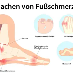 Illustration zeigt Ursachen von Fußschmerzen: Achillessehnenentzündung, Hallux valgus, Morton-Neuralgie, Hammerzeh, Fersensporn und mehr.