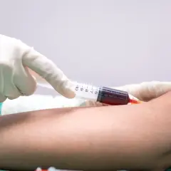 Pobieranie krwi do badań. Lekarz w rękawiczce pobiera strzykawką krew, która może wskazywać, że mpv za wysokie.
