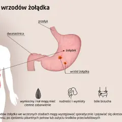 Ilustracja przedstawia objawy wrzodów żołądka: nalot na języku, brak apetytu, zgaga, bóle brzucha, wzdęcia, wymioty.