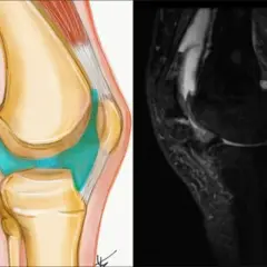 Ilustracja anatomiczna i rezonans magnetyczny ukazują torbiel Bakera w dole podkolanowym, wypełnioną płynem.