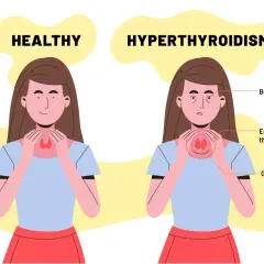Confronto tra tiroide sana e ipertiroidismo: occhi sporgenti, tiroide ingrossata e gozzo indicano quando gli anticorpi anti-tireoperossidasi alti sono motivo di preoccupazione.