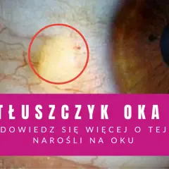 Zbliżenie na oko z żółtawym tłuszczykiem otoczonym czerwonym okręgiem.