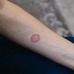 Lesione circolare arrossata e squamosa sul braccio, sintomo di tigna sulla pelle.