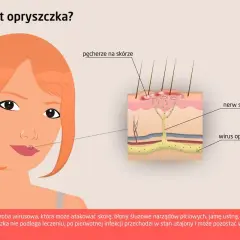 Jak zapobiegać opryszczce? Skuteczna profilaktyka i dieta