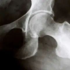 RTG stawu biodrowego z widocznym zwyrodnieniem. Kości są nierówne, z osteofitami, co wskazuje na chorobę zwyrodnieniową stawu biodrowego.