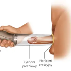 Pompka erekcyjna apteka: ilustracja pokazuje użycie cylindra próżniowego i pierścienia erekcyjnego do wspomagania erekcji.