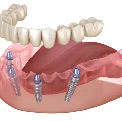Górna proteza zębowa opiera się na implantach wszczepionych w szczękę. Widok z boku ukazuje cztery implanty.