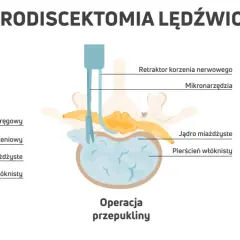 Ilustracja pokazuje mikrodiscektomię lędźwiową, zabieg leczenia rwy kulszowej. Widzimy przepuklinę krążka międzykręgowego uciskającą nerw.