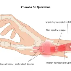 Anatomia dłoni z zaznaczonym stanem zapalnym ścięgien kciuka, wskazującym na chorobę De Quervaina. Pomocne przy ćwiczeniach na nadgarstek.