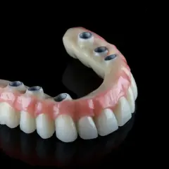 Protesi dentale mobile senza palato, con attacchi metallici per un sorriso fisso e naturale.
