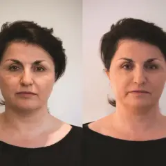 Porównanie twarzy kobiety przed i po zabiegu, ukazujące zmiany w wyglądzie.
