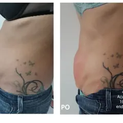 Przed i po zabiegach Accent Prime i endermologii. Widoczna redukcja tkanki tłuszczowej, efekt podobny do liposukcji kawitacyjnej.