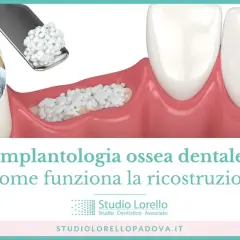 Ricostruzione ossea per implantologia dentale: due dentisti sorridono mentre un'immagine mostra il materiale per l'innesto osseo.