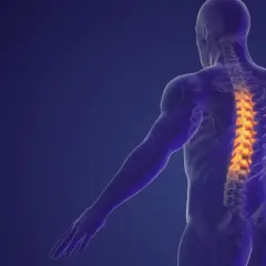 Anatomical model of a human torso showing a spine with highlighted areas indicating dyskopatia wielopoziomowa.