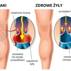 Porównanie żylaków i zdrowych żył. W żylakach zastawka nie działa, powodując zastój krwi. W zdrowych żyłach zastawka zamyka się prawidłowo.