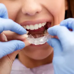 Manos con guantes azules colocan un alineador transparente. La sonrisa de la mujer muestra el progreso de su evolución Invisalign mes a mes.