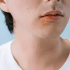 Zbliżenie na usta z widocznymi pęcherzykami opryszczki. Szukasz sposobu na opryszczkę w 1 dzień?