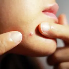 Dedos manipulando un grano rojo en la mejilla. Aprende como curar un grano explotado para evitar cicatrices.
