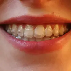 Sonrisa con alineadores transparentes, buscando blanquear Invisalign para una sonrisa radiante.