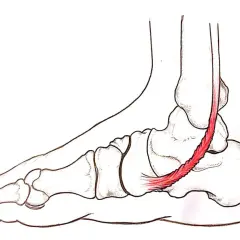 Illustrazione anatomica del piede con tendine d'Achille infiammato, evidenziando la **tendinite caviglia**.