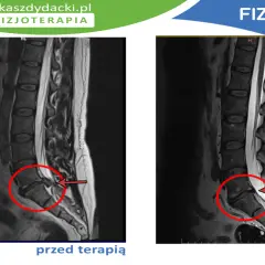 Przed i po terapii: rezonans magnetyczny kręgosłupa z widoczną dyskopatią L5/S1, która po leczeniu uległa poprawie.