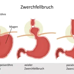 Illustrationen zeigen Zwerchfellbruch-Arten. Symptome bei Frauen können vielfältig sein, hier axialer und paraösophagealer Bruch.