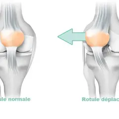 Comparaison d'une rotule normale et d'une rotule déplacée, illustrant la **dysplasie femoro patellaire**.