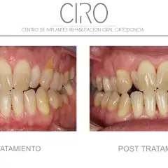 Comparación antes y después de un tratamiento de mantenimiento periodontal. Dientes amarillentos y encías inflamadas antes, y dientes limpios y encías sanas después.