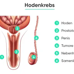Anatomische Darstellung des männlichen Genitalbereichs mit Beschriftungen. Ein Tumor (4) ist im Hoden (1) zu sehen. Die Hodenkrebs prognose hängt vom Stadium ab.