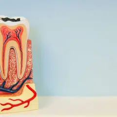 Modelo dental muestra caries profunda, exponiendo la pulpa dental. Se aprecian nervios y vasos sanguíneos.