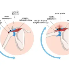 Anatomia barku: prawidłowe ułożenie ścięgna mięśnia nadgrzebieniowego i kaletki podbarkowej, a następnie ucisk na obojczyk podczas ruchu.