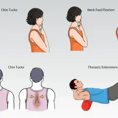 Esercizi per correggere la sindrome della testa in avanti: chin tucks, flessione del collo e estensioni toraciche con rullo.