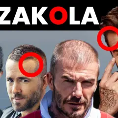 ZAKOLA. Czterech mężczyzn z widocznym łysieniem androgenowym, zaznaczone czerwonymi okręgami. Fryzura w kontekście utraty włosów.