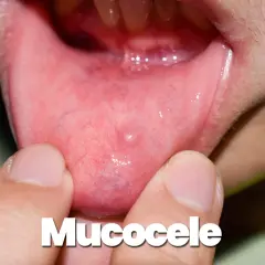 Piccolo rigonfiamento biancastro sul labbro inferiore, una lesione labbro inferiore che sembra un mucocele.