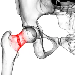 3D-Darstellung des menschlichen Beckens mit rot hervorgehobenem Oberschenkelhalsbruch, eine häufige Verletzung im Alter.