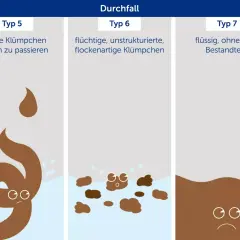 Durchfall: Typ 7 zeigt flüssigen, hellbraunen Stuhl wie Wasser, ohne feste Bestandteile.